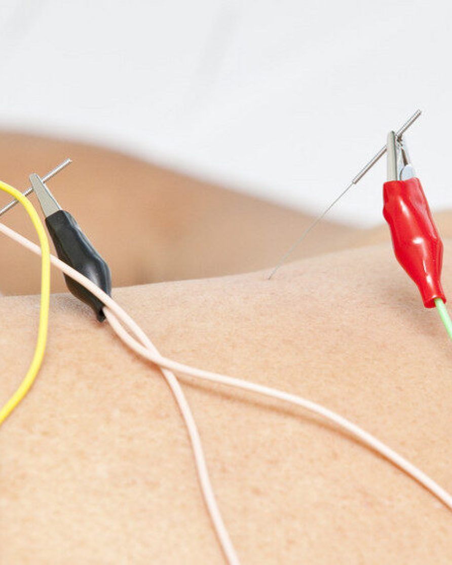 Electro-Acupuncture